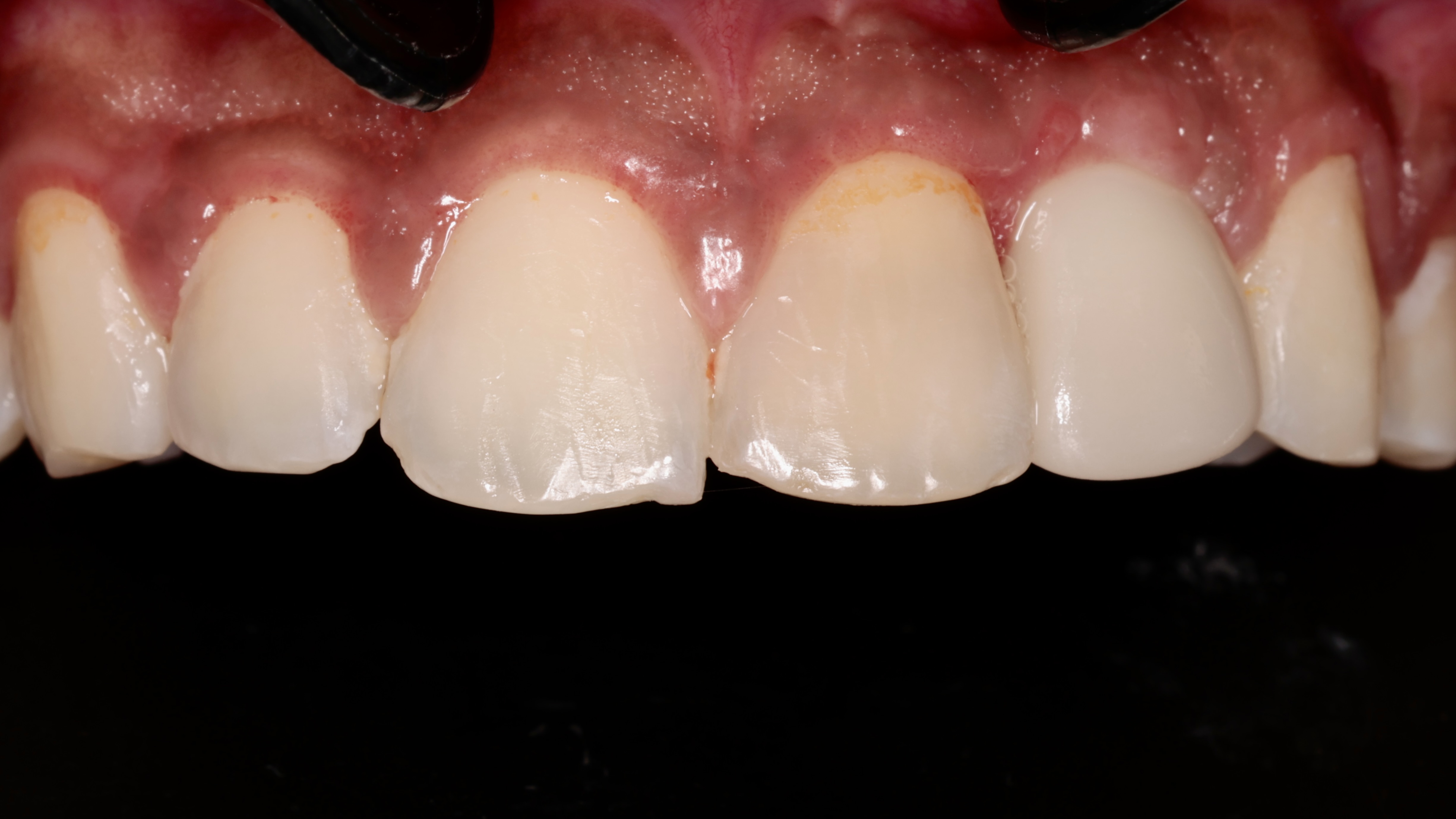 Post-operative Result